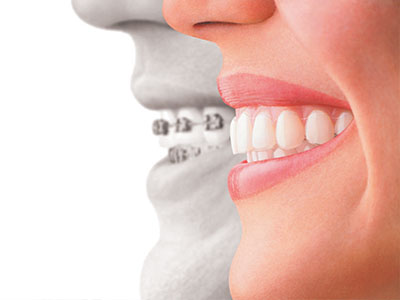 Maarten Broess DDS, DMSc, DMD, PC | Interceptive Orthodontics, Mouthguards and Adult Orthodontics