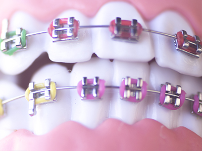 Maarten Broess DDS, DMSc, DMD, PC | Two-Phase Treatment, Mouthguards and Orthodontic Retainers