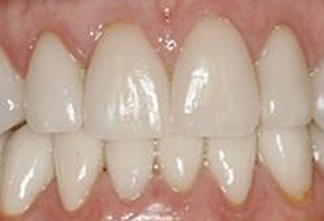 Maarten Broess DDS, DMSc, DMD, PC | Clear Braces, Fixed Metal or Ceramic Braces and Generic Clear Braces