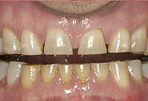 Maarten Broess DDS, DMSc, DMD, PC | Mouthguards, Generic Clear Braces and Invisalign reg 