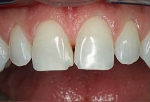 Maarten Broess DDS, DMSc, DMD, PC | Mouthguards, Invisalign reg  and Two-Phase Treatment